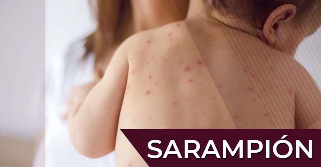 Picaduras de sarampión en la piel infantil, síntomas y prevención saludable.