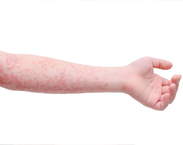 Registra Guanajuato 10 casos de sarampión